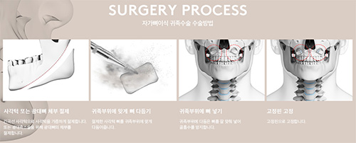 韩国345整形轮廓技术