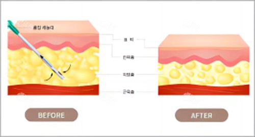 抽脂脂肪前后对比图