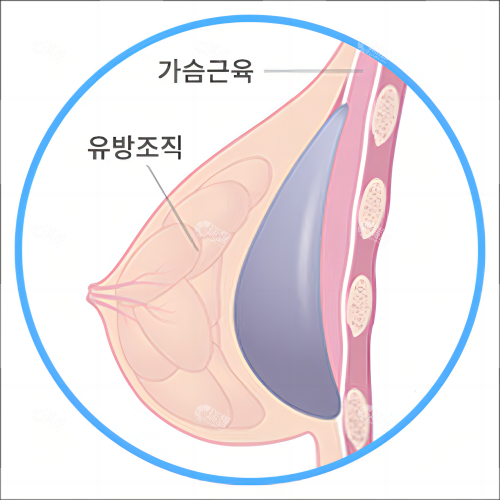 乳房植入假体素材