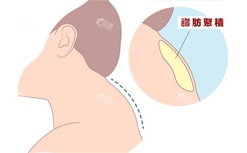富贵包脂肪示例图