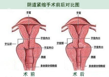 阴道缩紧手术